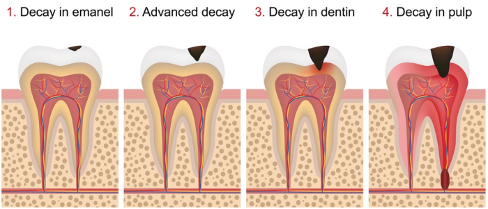 The　four　stages　of　tooth　decay