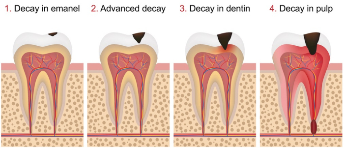 The four stages of tooth decay