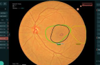 Vuno's fundus-reading AI obtains medical device certification in Thailand 