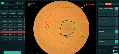 Vuno's　fundus-reading　AI　solution