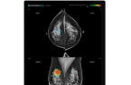 Lunit to export breast cancer detecting solutions to Hong Kong, Mongolia