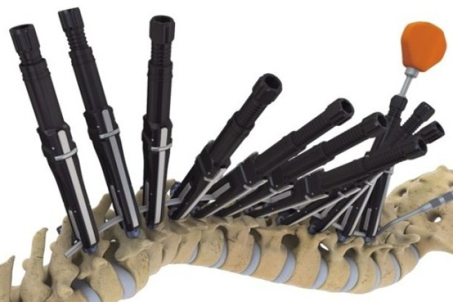 Demonstration of the use of LumFix MDR for spinal angle correction