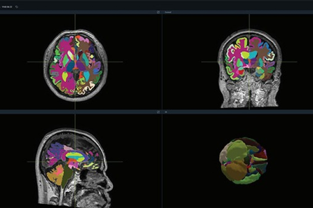 Vuno's　brain　imaging　AI　medical　device　secures　FDA　certification　
