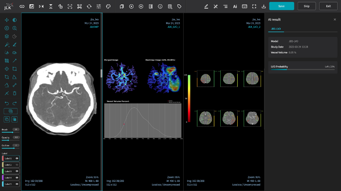 JBS-LVO,　JLK's　AI-based　early-detection　platform　for　cerebrovascular　diseases