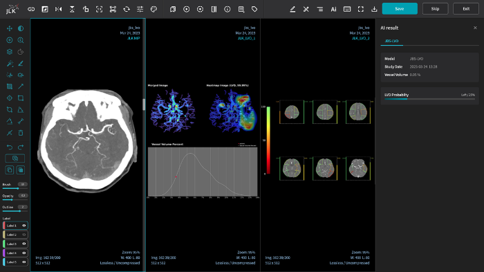 JBS-LVO, JLK's AI-based early-detection platform for cerebrovascular diseases