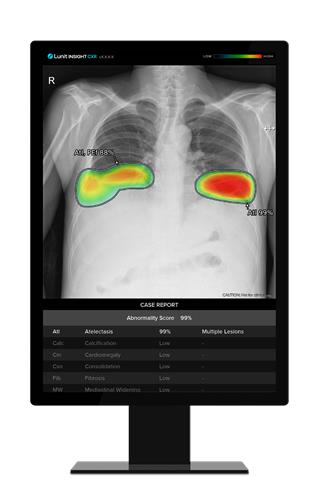 Lunit　Insight　CXR