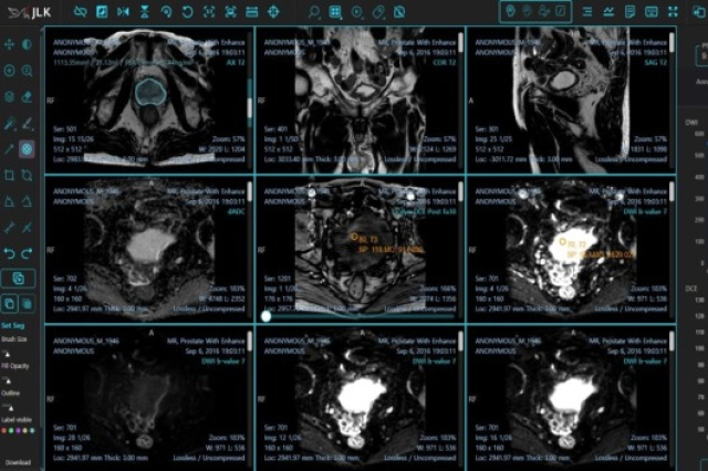 JLK　gets　FDA　OK　for　prostate　cancer　diagnosis　AI　solution